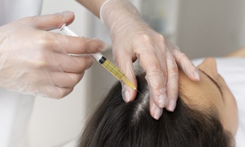 high-angle-woman-getting-scalp-prp-treatment
