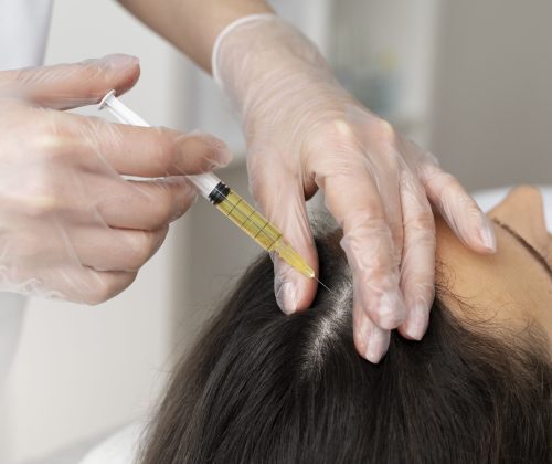 high-angle-woman-getting-scalp-prp-treatment